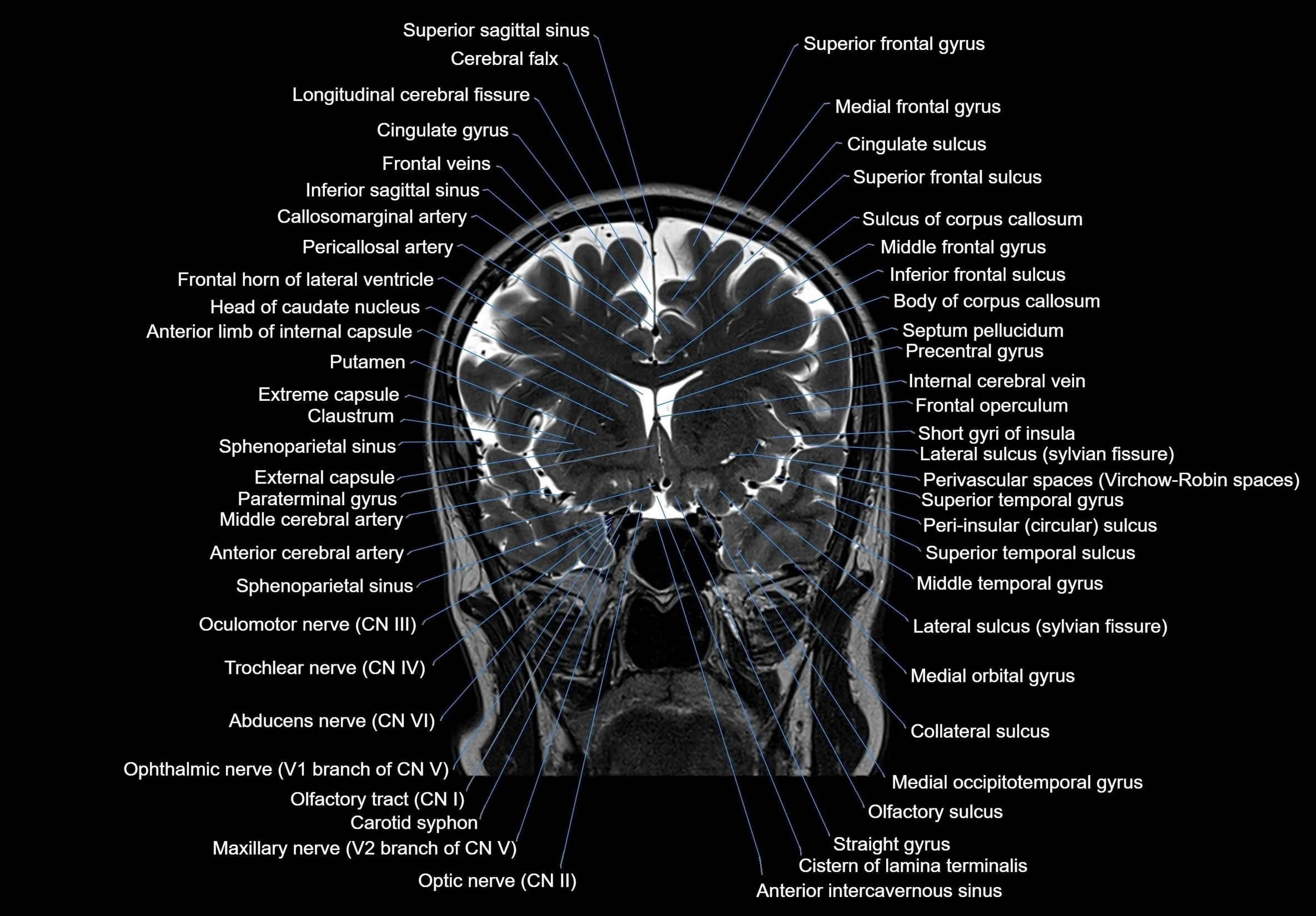 MRI Brain coronal cross sectional labelled anatomy 3T image  -img-00001-00029.webp